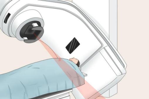 乳腺癌质子放疗后有哪些不良反应,乳腺癌放疗的反应有哪些