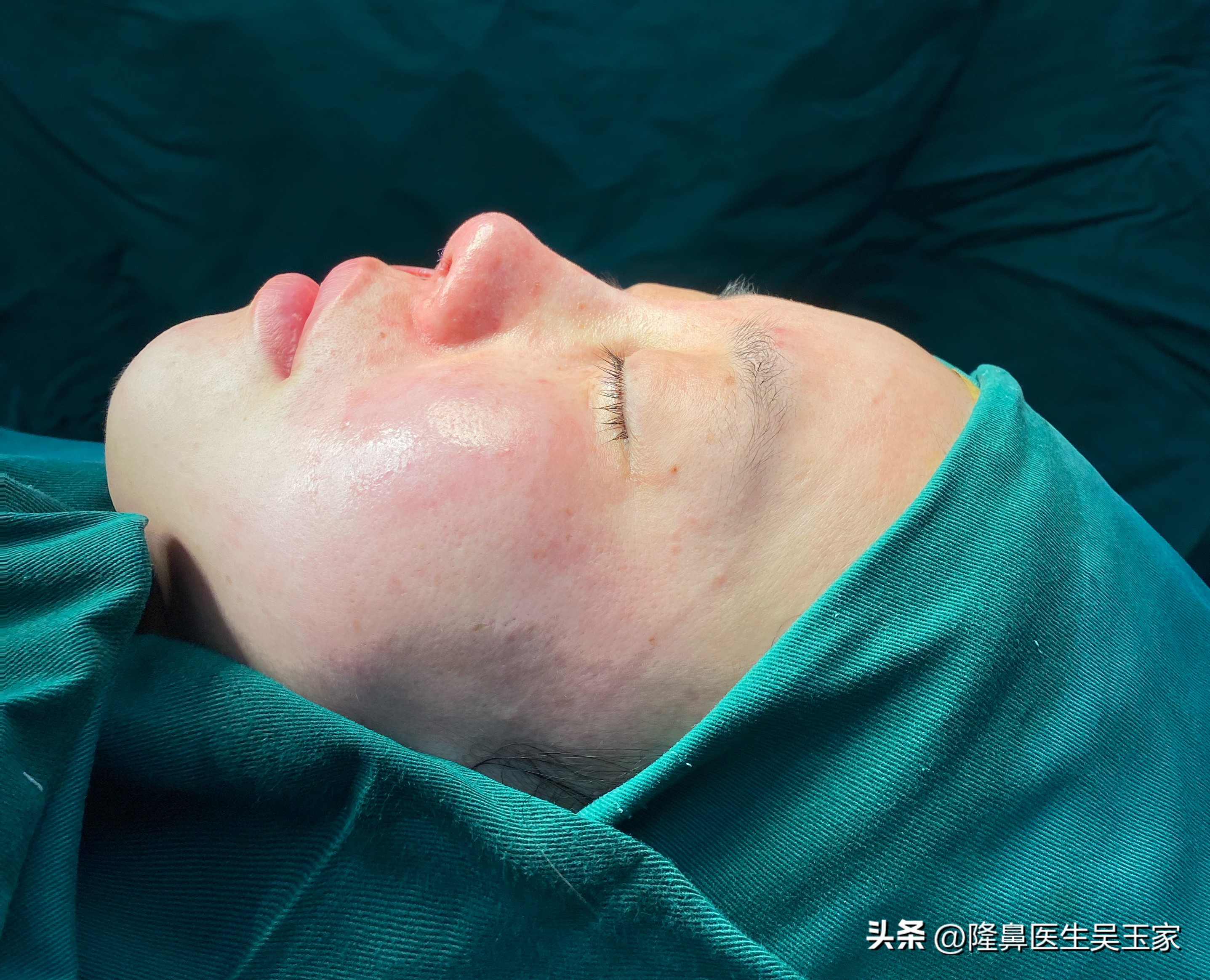 天津28岁姑娘动手术,29岁女子瞒着家人整容