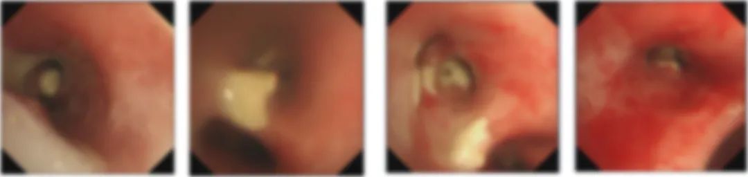 肺部长蘑菇是什么病,肺部有蘑菇结节