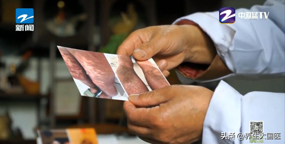 疑难皮肤病中医治疗,治疗皮肤疮毒经典名方