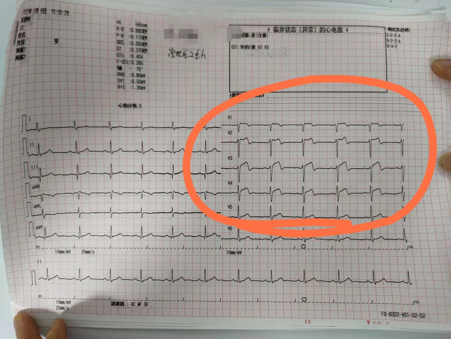80岁老人得心梗无法手术无法溶栓,42岁突发心梗已下支架