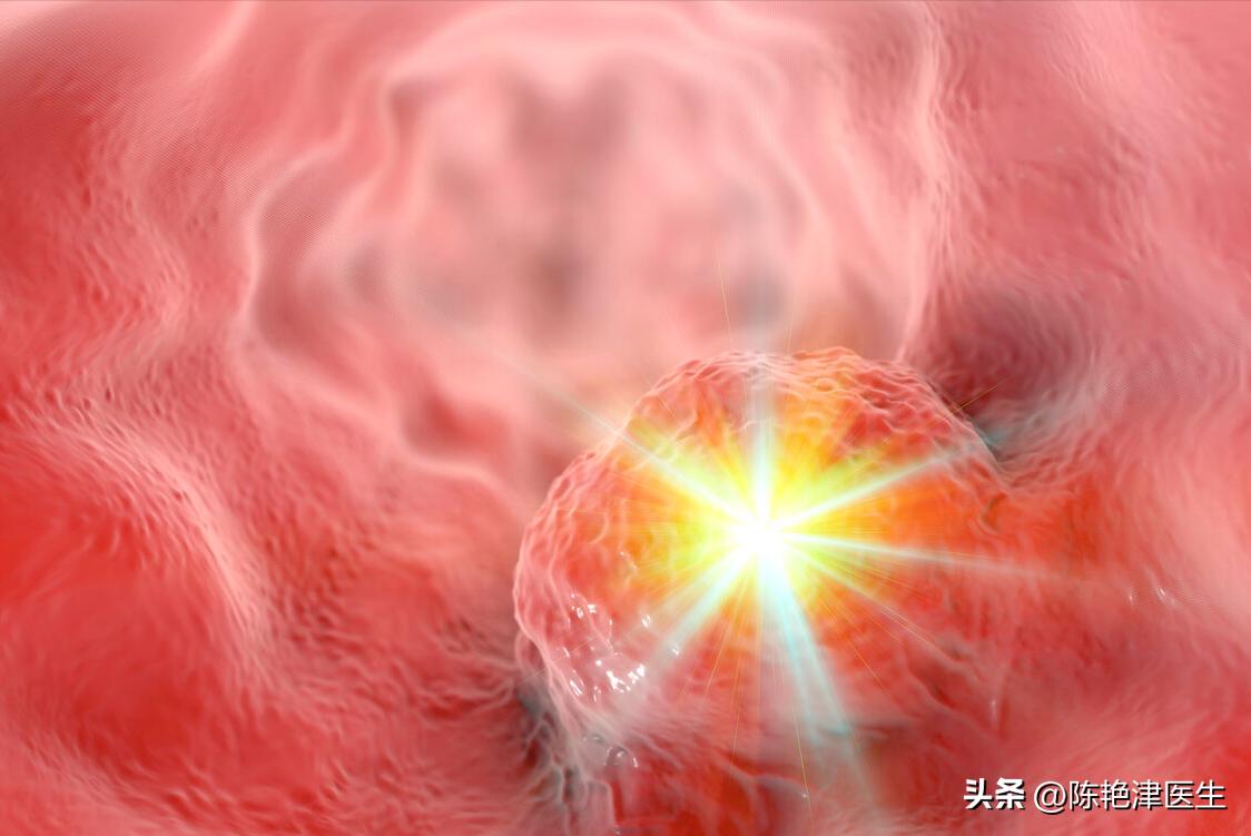 咽炎查出食管癌,以为是慢性咽炎却是食管癌