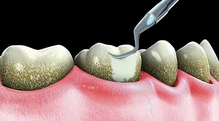 牙结石可以直接抠掉吗,牙结石能直接抠下来吗