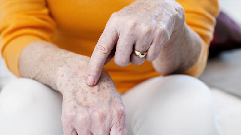 红霉素软膏可以治疗手上老年斑,红霉素软膏可以去除老年斑么