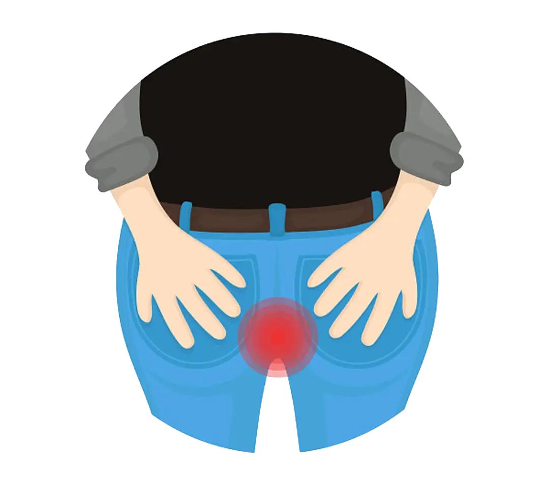 菊花痒到坐立难安？可能是肛毛太多惹的祸