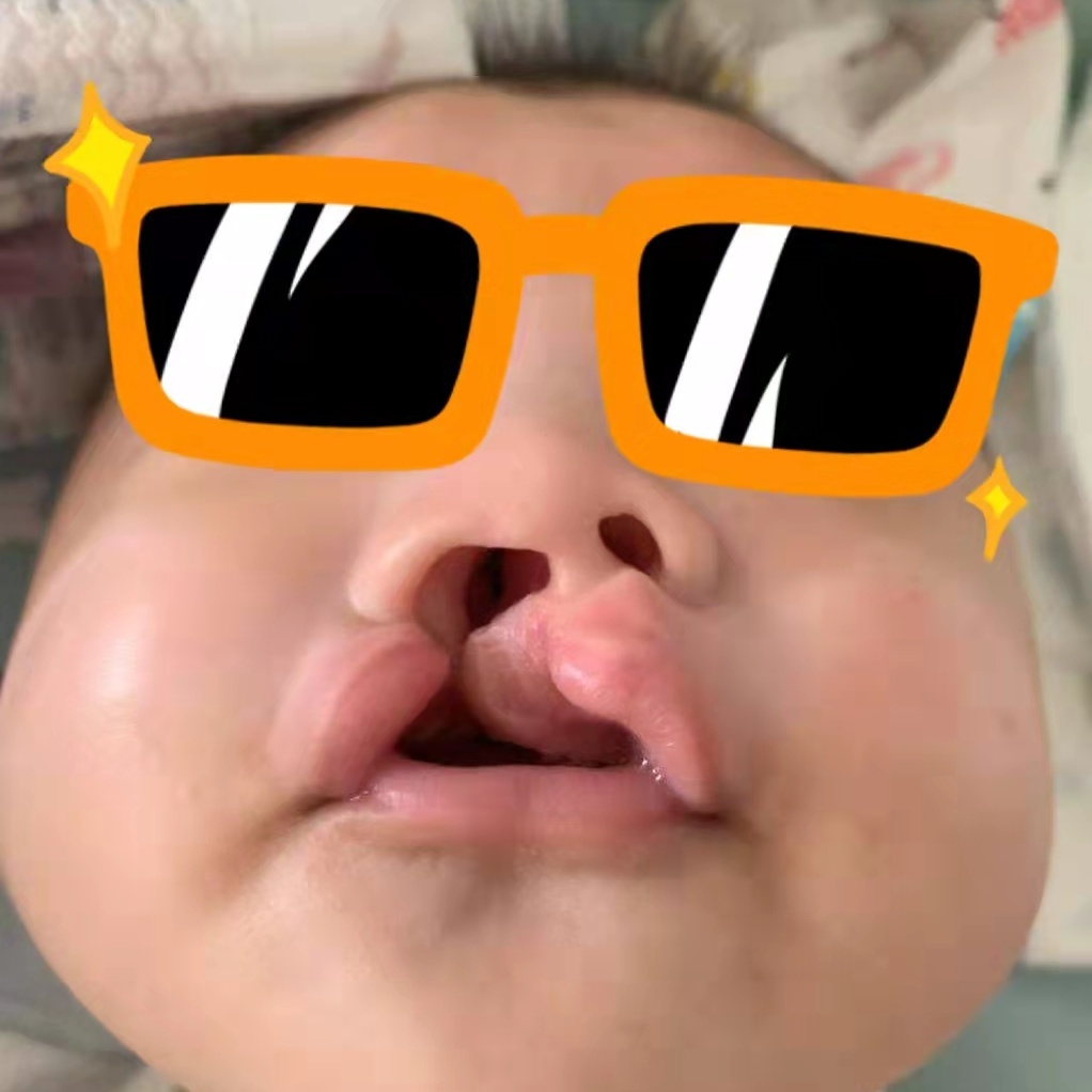 宝宝是一只“小兔子”，还没长牙就要开始正畸了