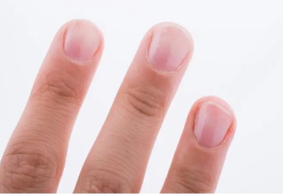 指甲竖纹与肝脏的关系,指甲盖有竖纹凸起是肝有病吗