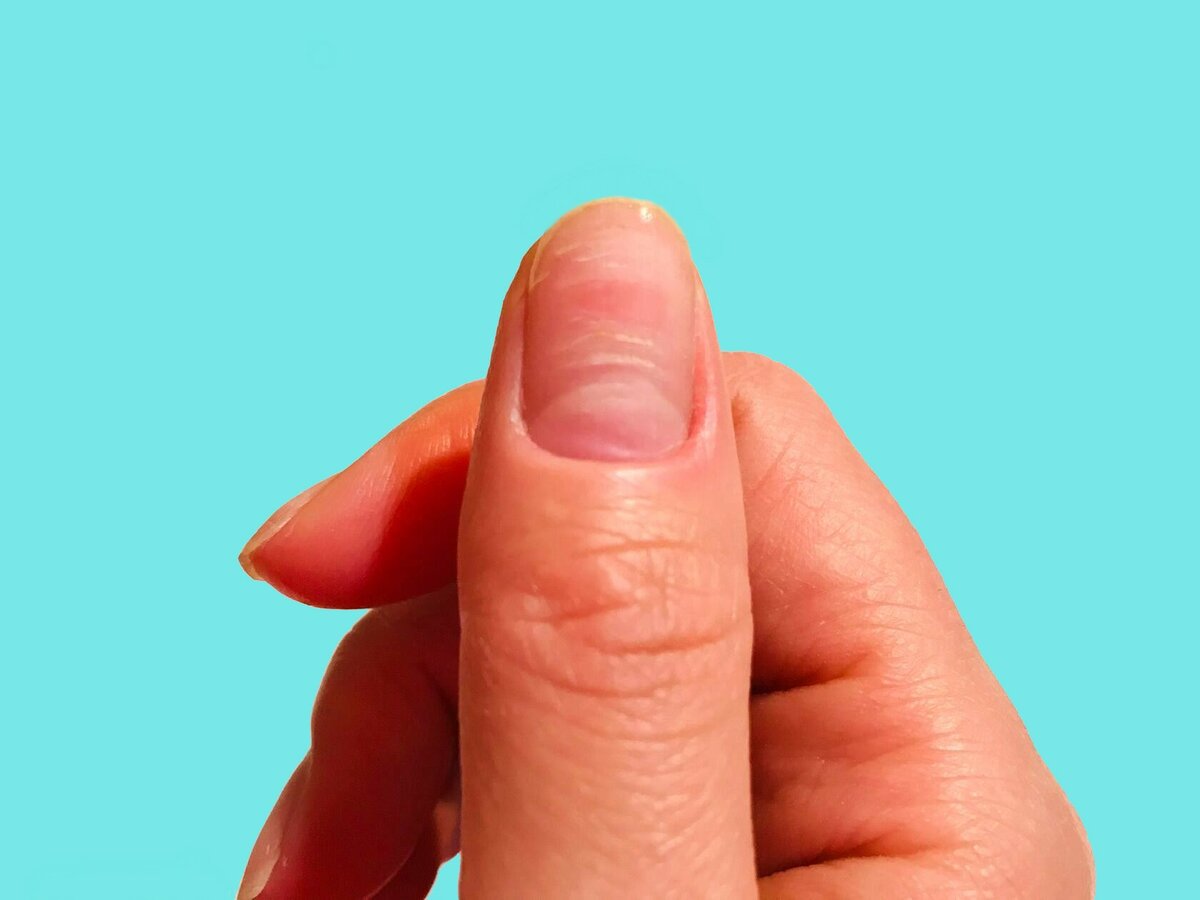 指甲渐变有条纹怎么解决,指甲薄有竖纹容易开裂不易长出来