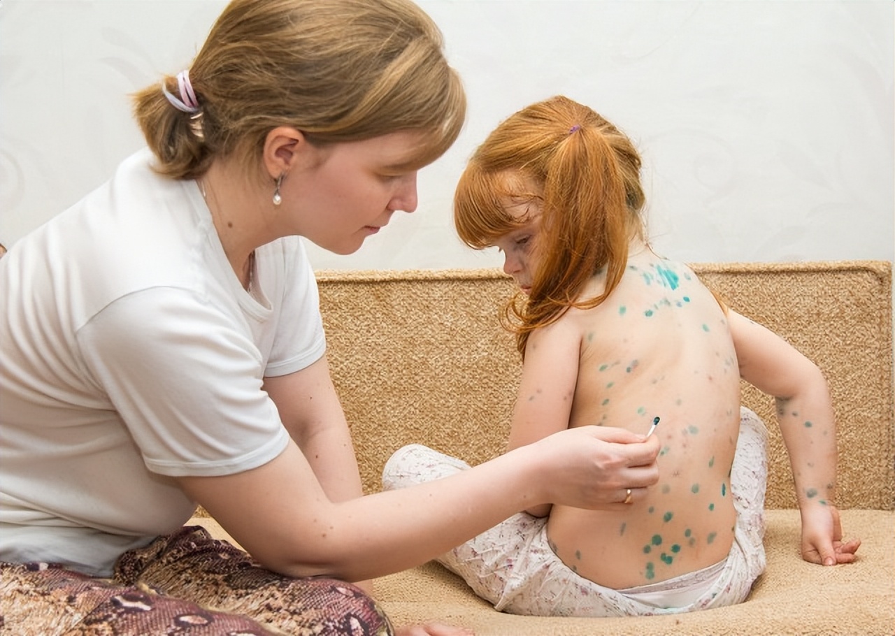 疱疹水痘怎么治疗效果最好,单纯疱疹和小时候水痘有关系吗