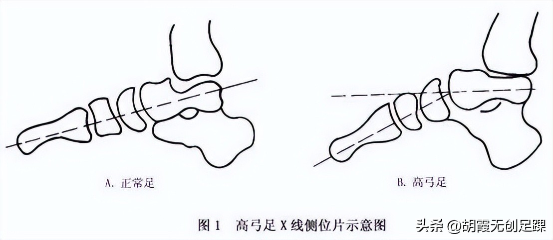 高弓足外翻怎么治疗,高弓足与扁平足哪种易治疗