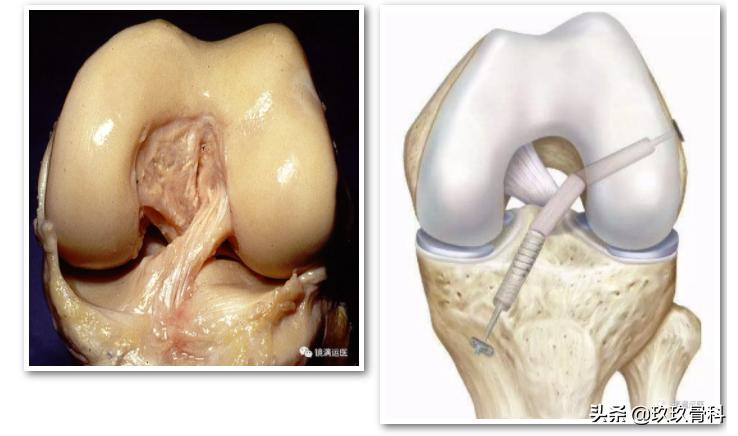 膝关节交叉韧带重建拄拐负重多少,膝关节后交叉韧带重建后康复训练