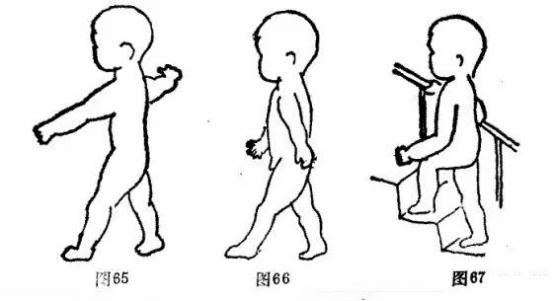 脑瘫儿童康复训练走路,脑瘫患者步行分解训练的6个步骤