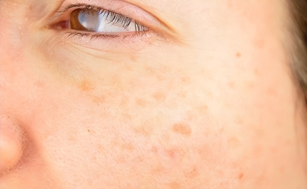 老年斑的克星牙膏怎么用,什么牙膏可以淡化老年斑