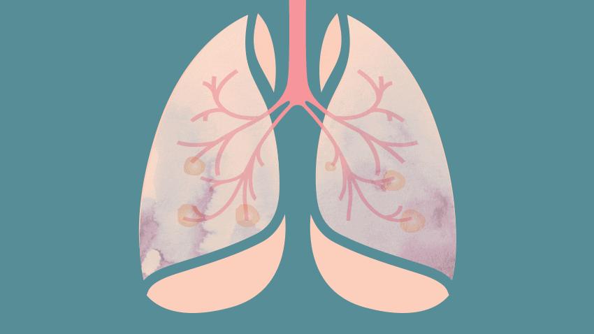 肺结节怎么确认是癌,肺结节怎么尽快确定是不是癌