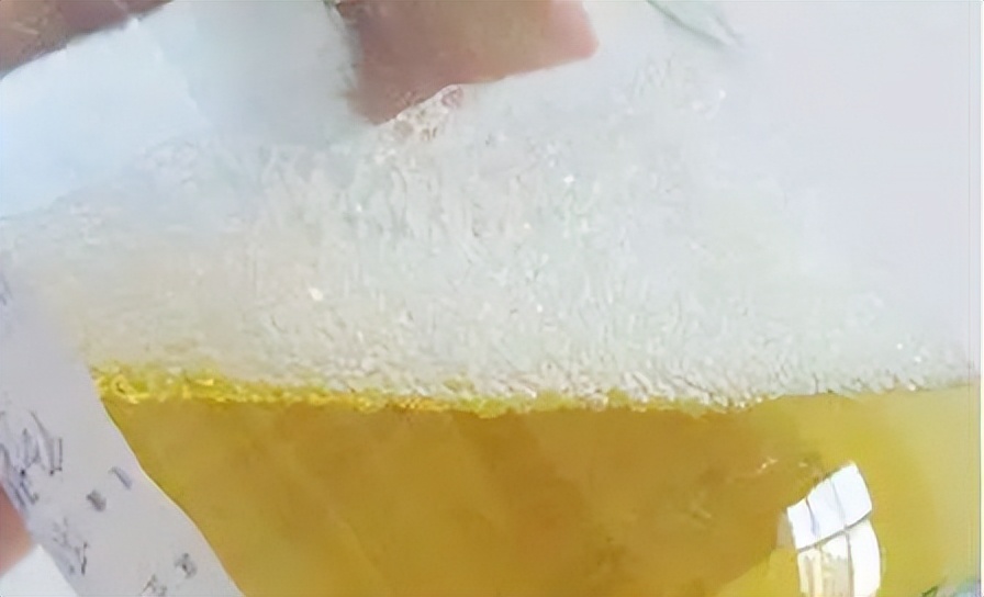 尿常规就能看出肾有问题吗,手把手教你看懂尿常规