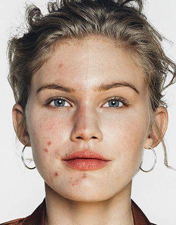 假期治痘最佳时期,如何快速消除熬夜痘