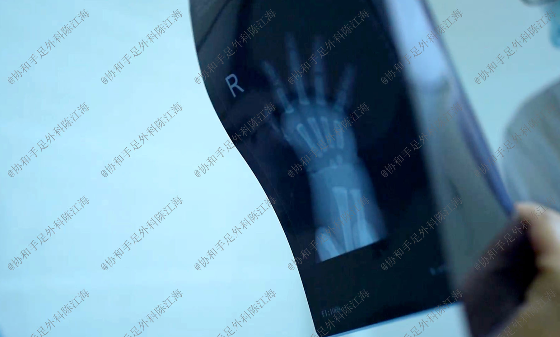 漂浮趾的治疗,拇指漂浮指的治疗方案