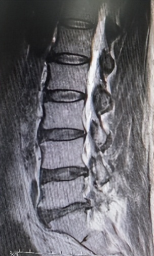 门医技术|门头沟区医院骨二科成功应用微创椎间孔镜技术治疗两例腰椎管多节段狭窄症