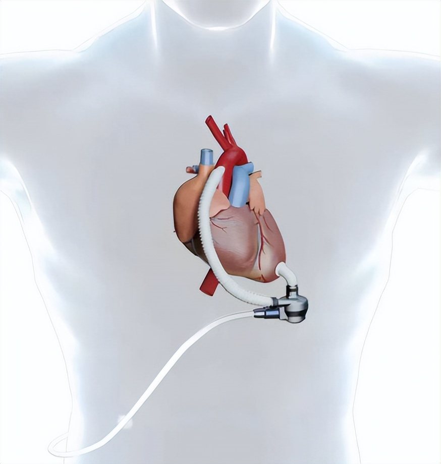 慢性心力衰竭的病因是什么,心力衰竭的原因和症状是什么