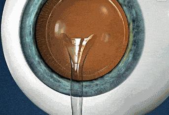 哪种近视手术对散光矫正更好,大散光为什么适合做近视矫正手术