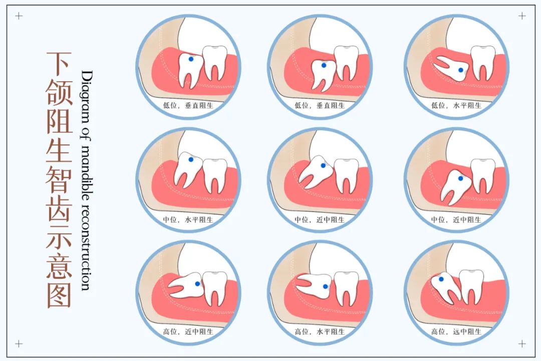 拔智齿医生说留了一点,拔智齿医生说有可能有后遗症