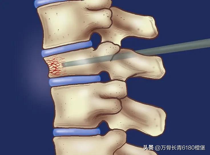 骨质疏松性椎体压缩骨折椎体强化术后康复治疗指南,2022版）