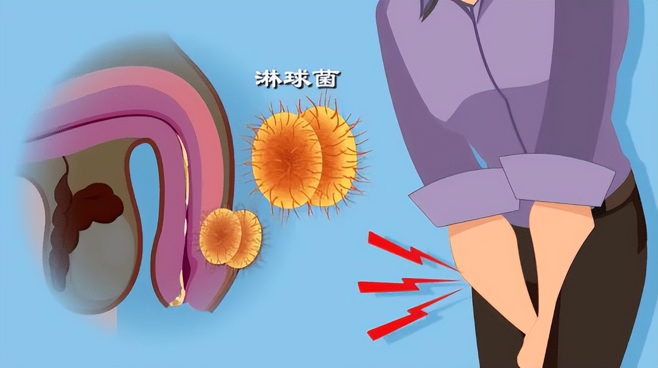 通过性传播的病有哪些不能治愈,8大性传播疾病可自测出来吗