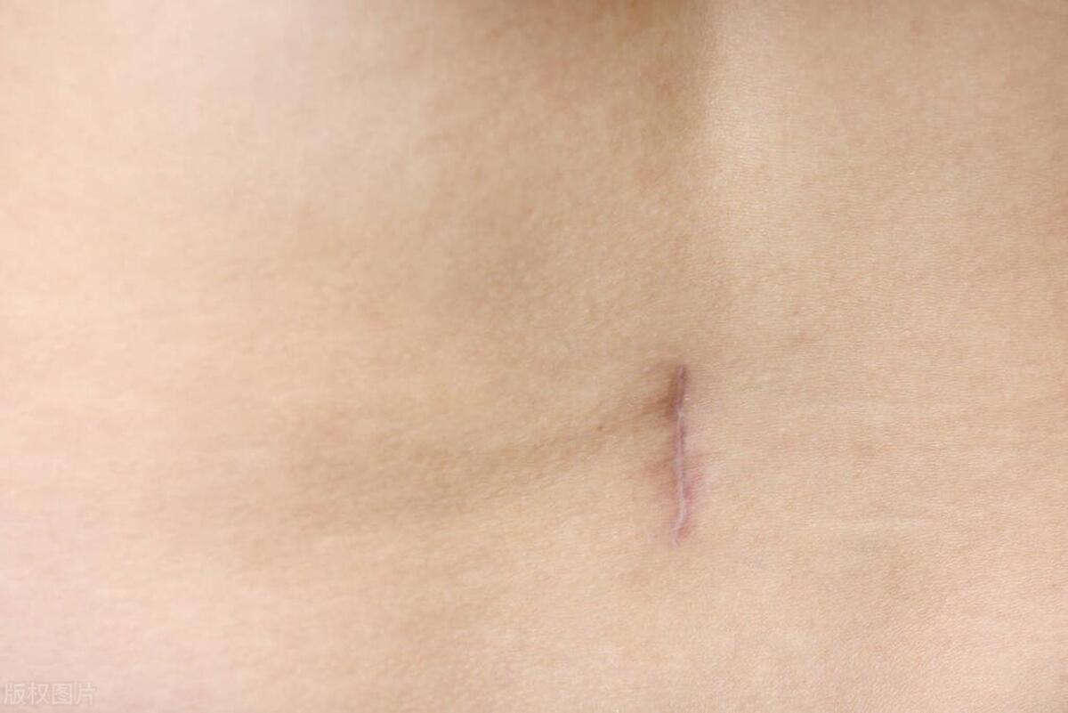 增生性疤痕如何治疗,肥厚性瘢痕怎么治疗有效果