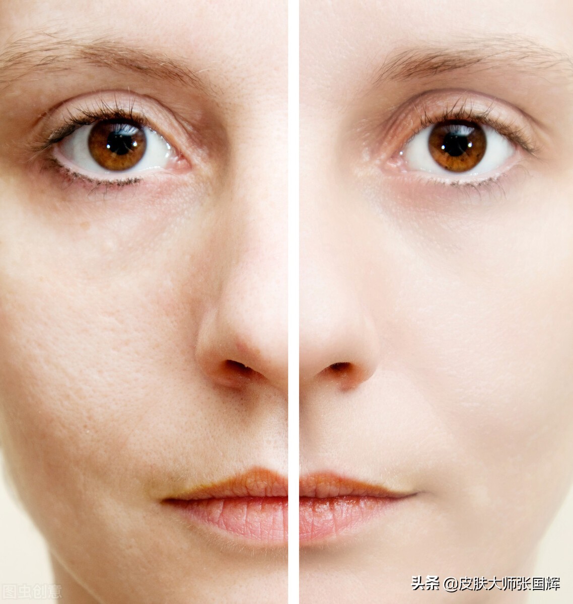 毛孔粗大的原因和治疗方法,毛孔粗大原因及改善方法