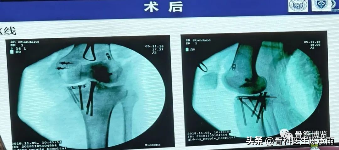 国家卫健委主办的骨创伤专项能力培训项目----下肢损伤学习班