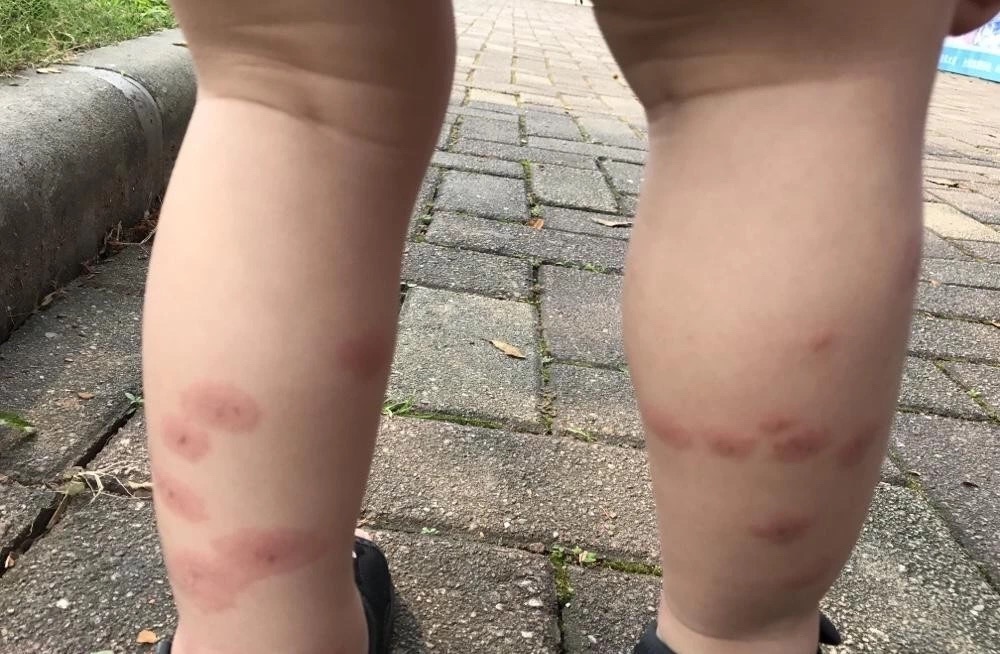 宝宝蚊虫叮咬止痒最有效的方法,宝宝蚊虫叮咬后止痒的方法