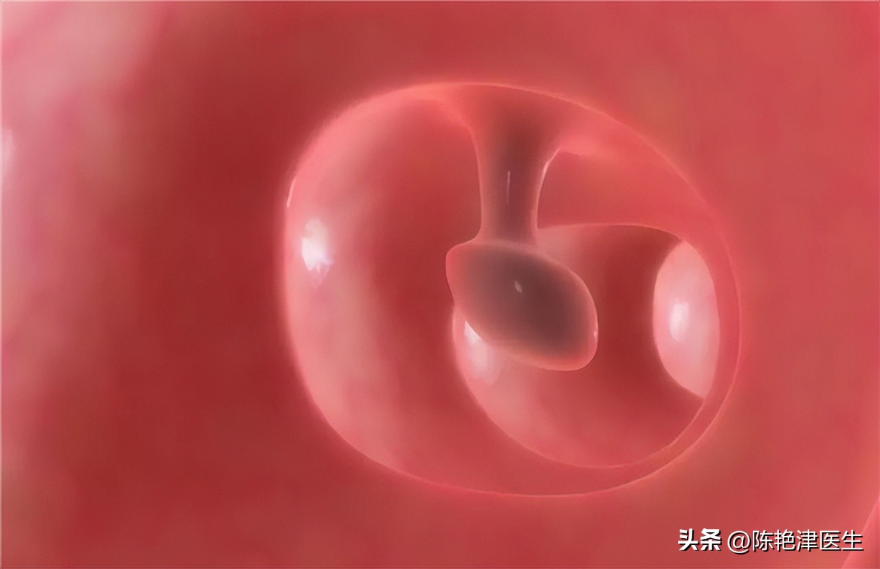 肠镜下治疗息肉最好方法,肠镜中的息肉怎么处理