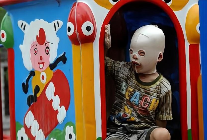 小孩被火烧伤戴面具,面具娃娃烧伤