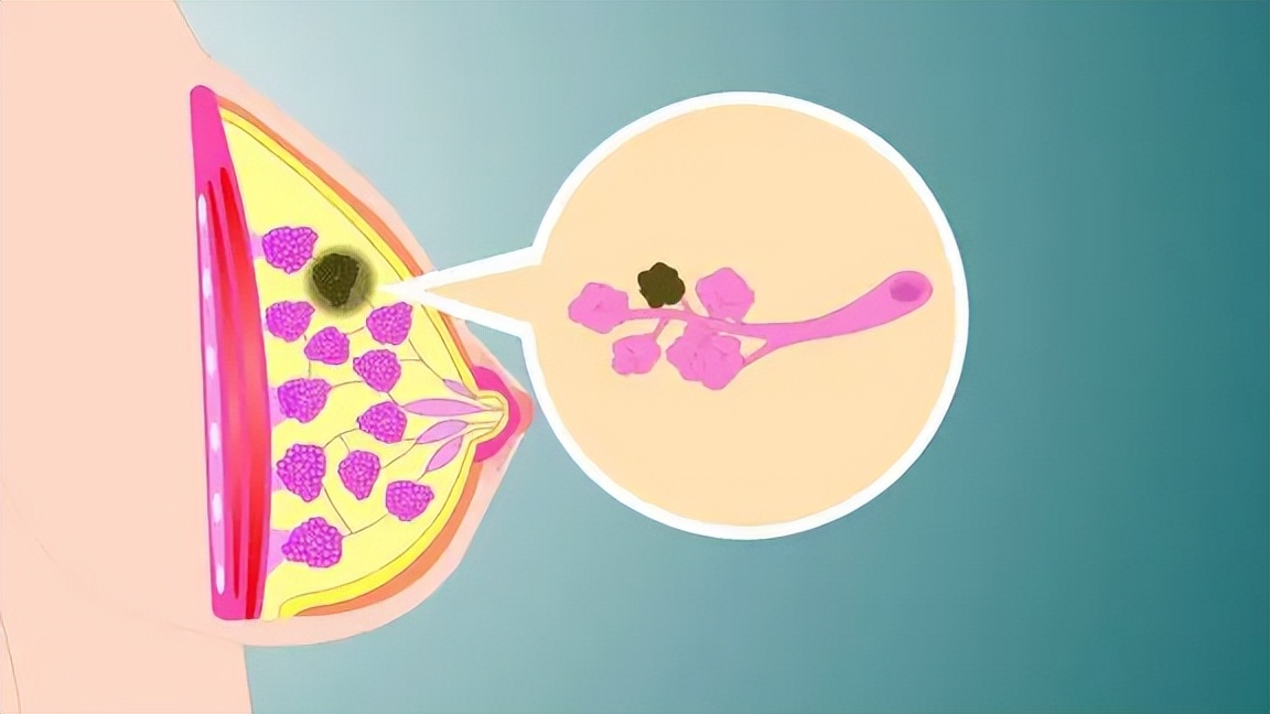 内分泌失调乳房疼月经不来,内分泌失调乳腺疼吃什么药