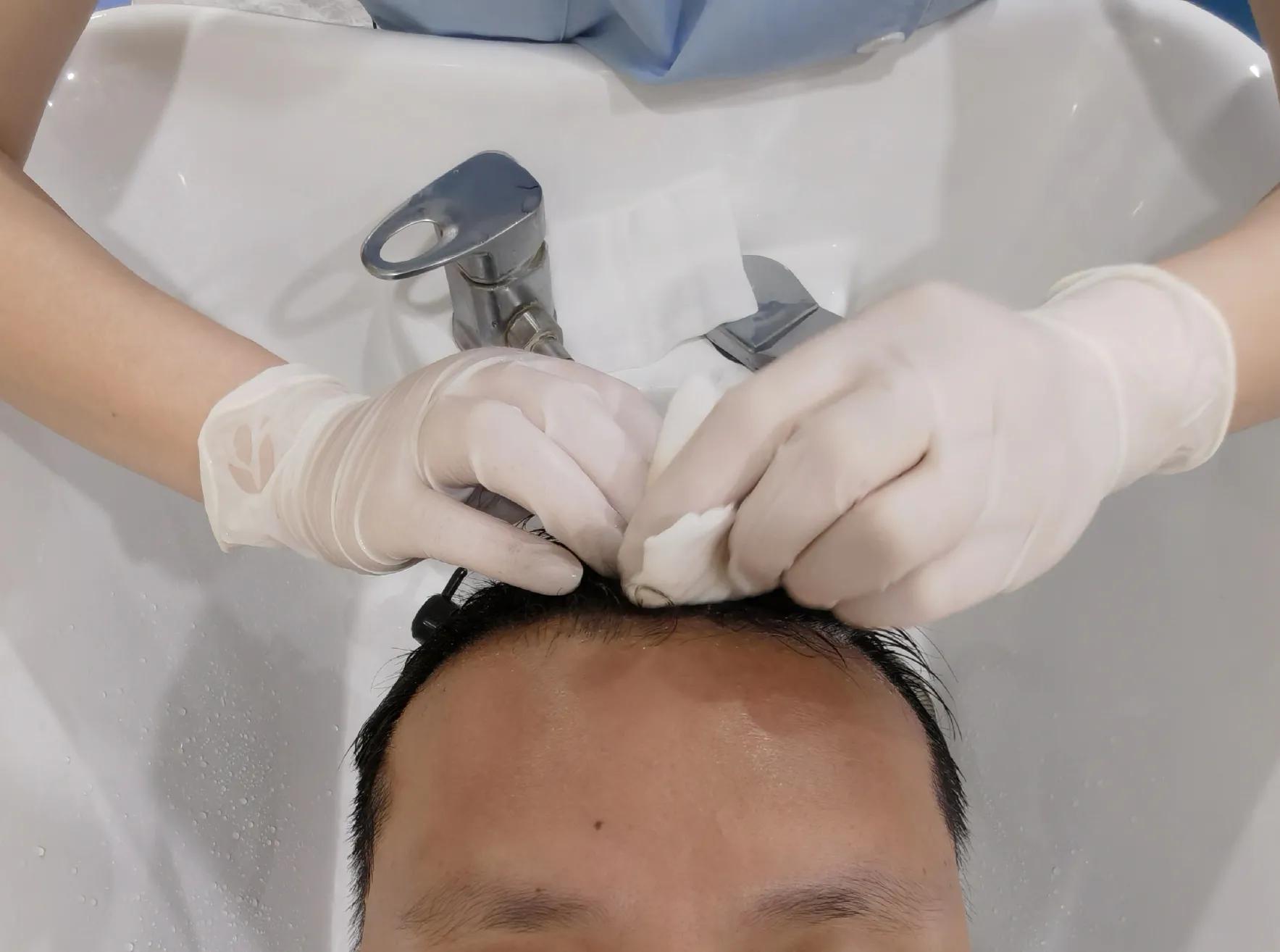 男士植发过来人真实感受,16000字讲述植发真实感受