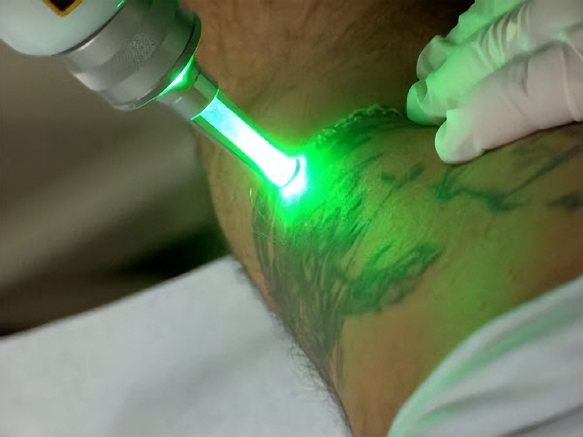 洗掉纹身需要多少钱一次,纹身一般多少钱能洗干净