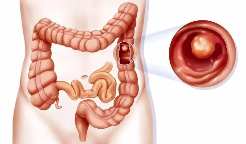 长期便血是不是容易导致贫血,长期便血会有什么后果