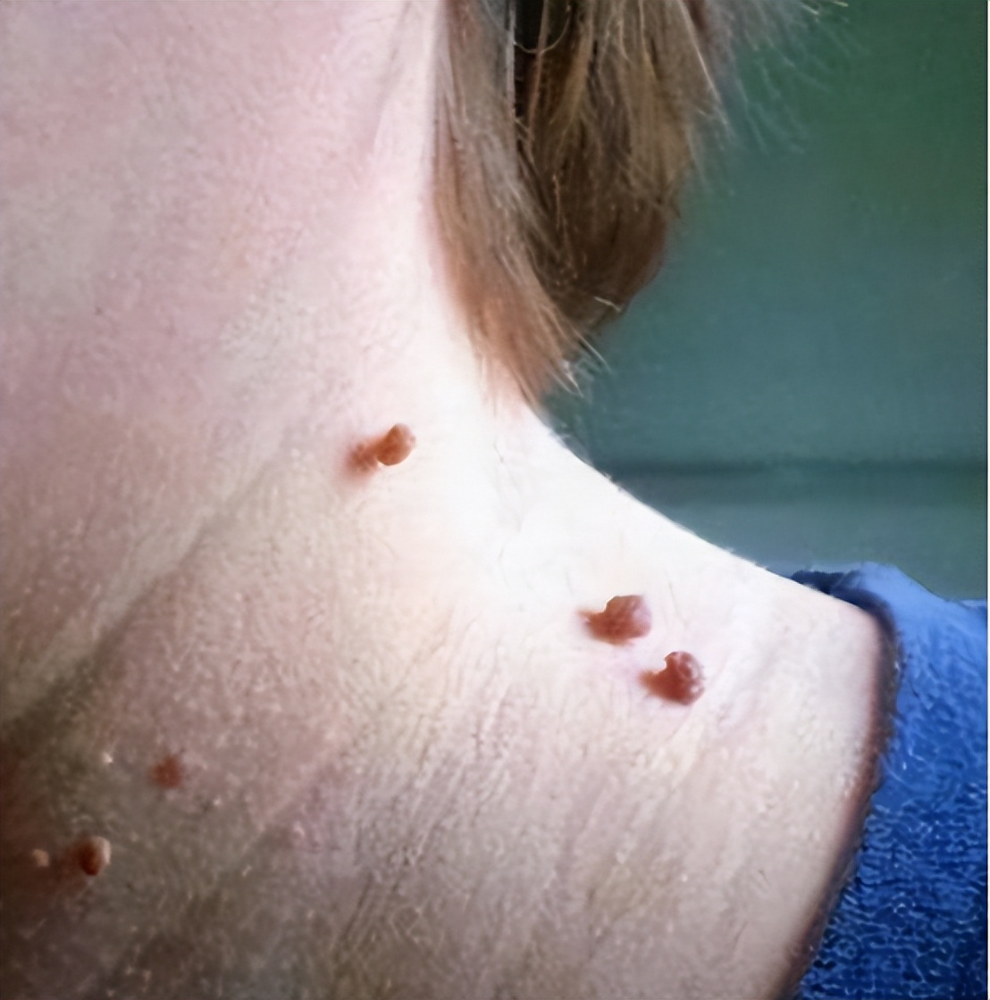 脖子上有丝状疣和皮赘怎么办,丝状疣和丝状皮赘怎么区别