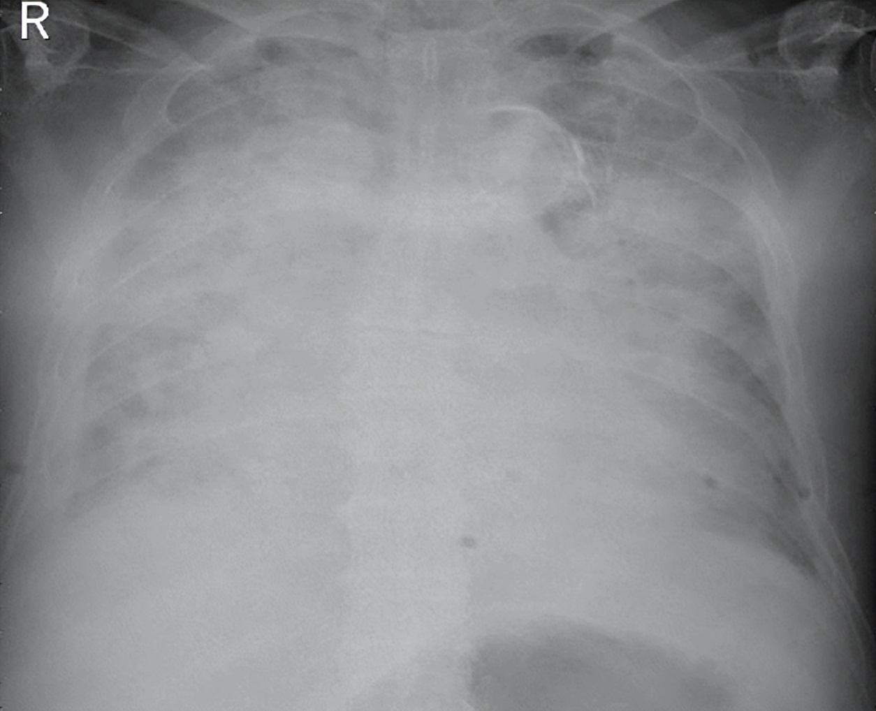 老人新冠后肺部感染严重多久恢复,新冠肺炎症状好转但病灶无明显吸收