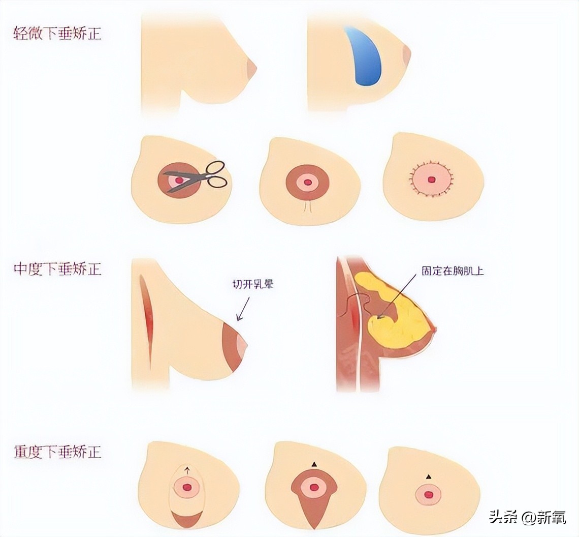 胸部明显大小不一怎么办,胸部越来越小是病理吗