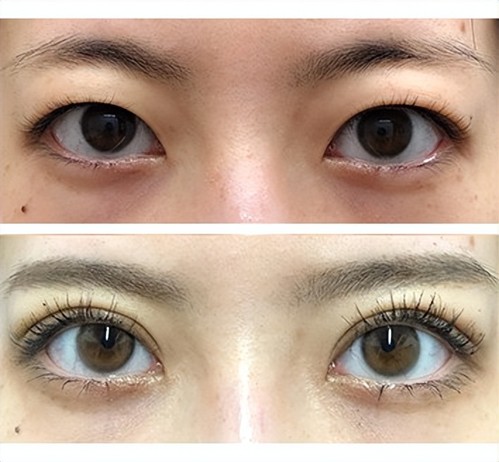 单眼皮肿眼泡去脂肪后适合埋线吗,单眼皮肿眼泡可以割薄一点吗