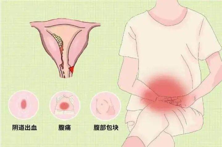 妇科恶性肿瘤5年生存率排行,妇科恶性肿瘤有哪些症状