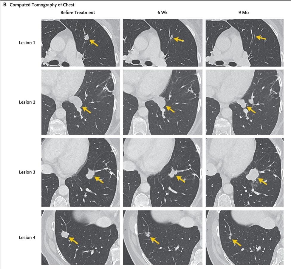 免疫疗法抗肿瘤效果图,央视新闻报道免疫细胞治疗癌症