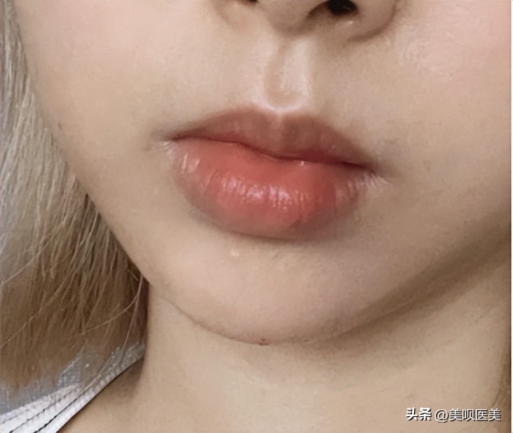 假玻尿酸毁容案例,玻尿酸注射如何避免网红脸