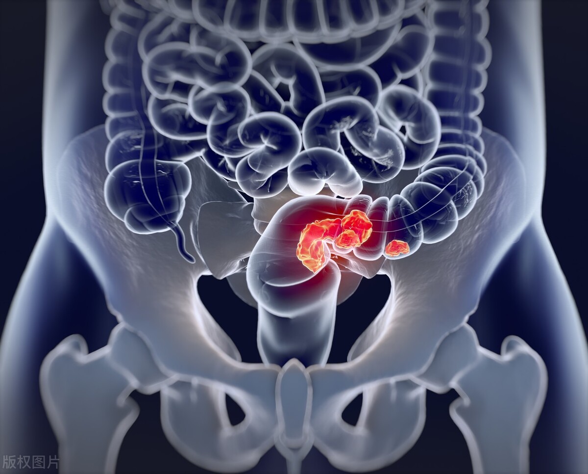 直肠癌晚期一般有什么症状？