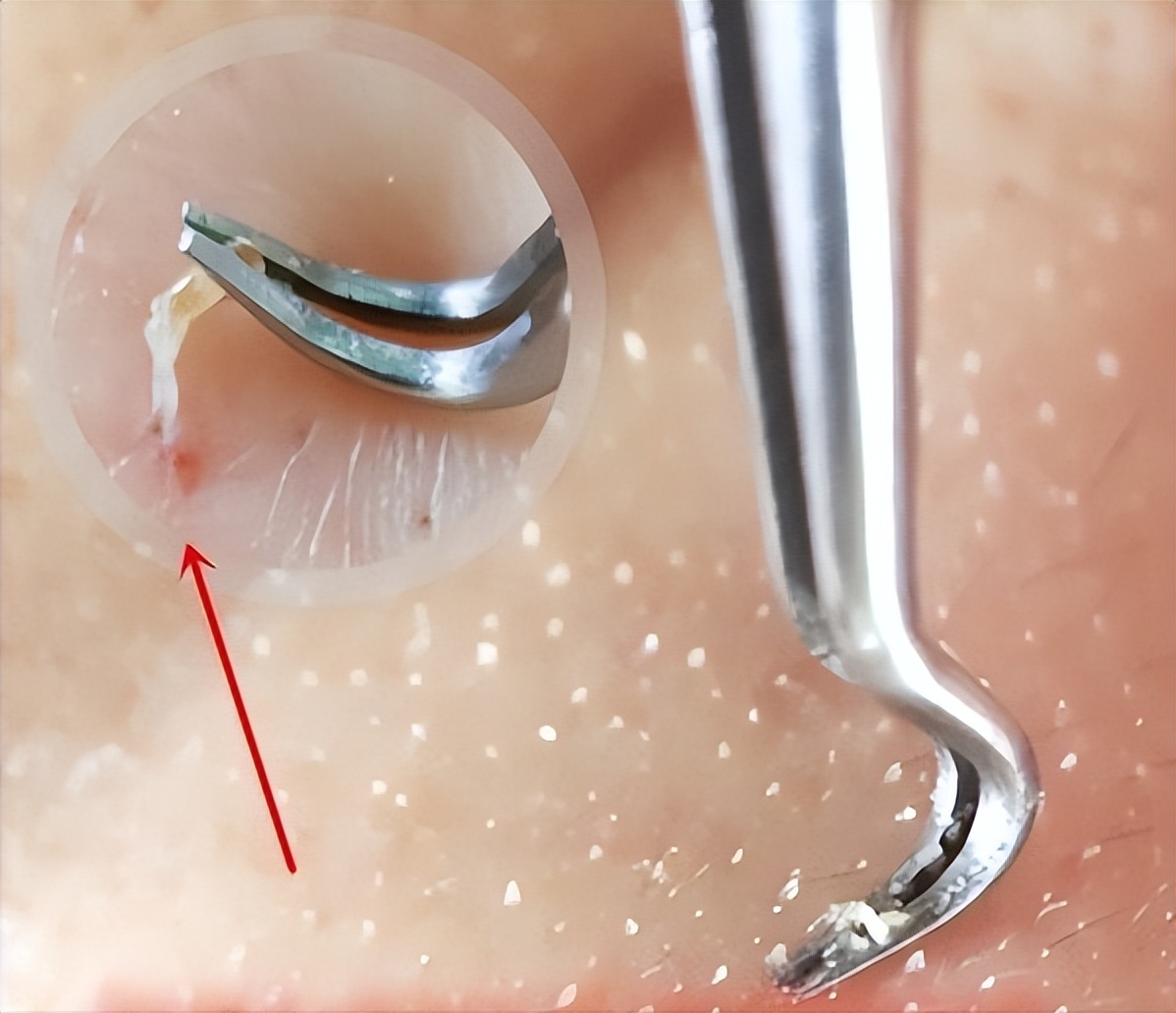 鼻子黑头里挤出的白色油脂怎么办,鼻子上有硬硬的黑头怎么办