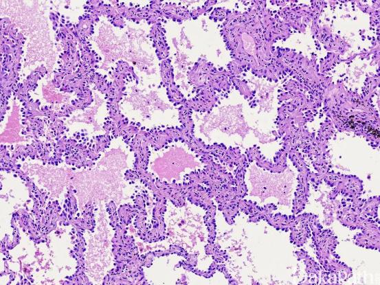 为什么肺原位腺癌术后不用放化疗,肺原位癌和肺腺癌有什么区别