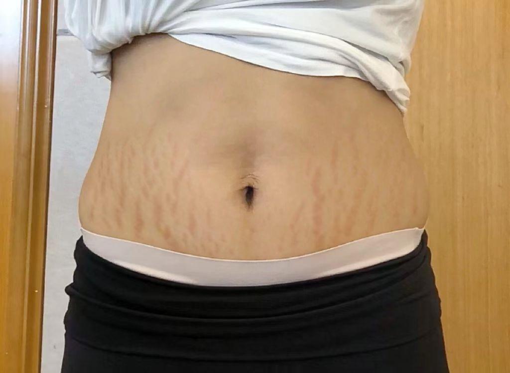 怀孕期间淡化妊娠纹的产品推荐,妊娠纹有没有好用有效果的产品