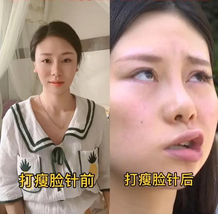 浙江28岁女子打瘦脸针导致面瘫,女子:可能终身恢复不了