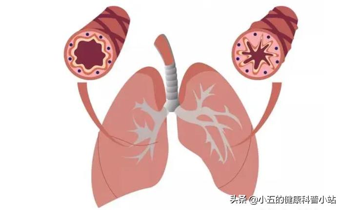 乙酰半胱氨酸治疗慢性支气管炎吗,乙酰半胱氨酸片直接口服